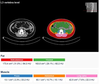 Do body composition parameters correlate with response to targeted therapy in ER+/HER2- metastatic breast cancer patients? Role of sarcopenia and obesity